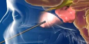 Você conhece a neuroendocospia?