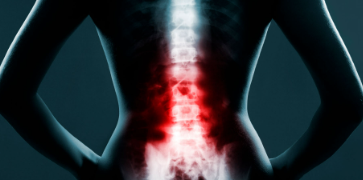 O que é a pseudoartrose em cirurgias de coluna?