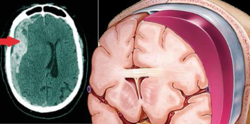 Você já ouviu falar em tratamento clínico e por cateterismo para o hematoma subdural crônico?